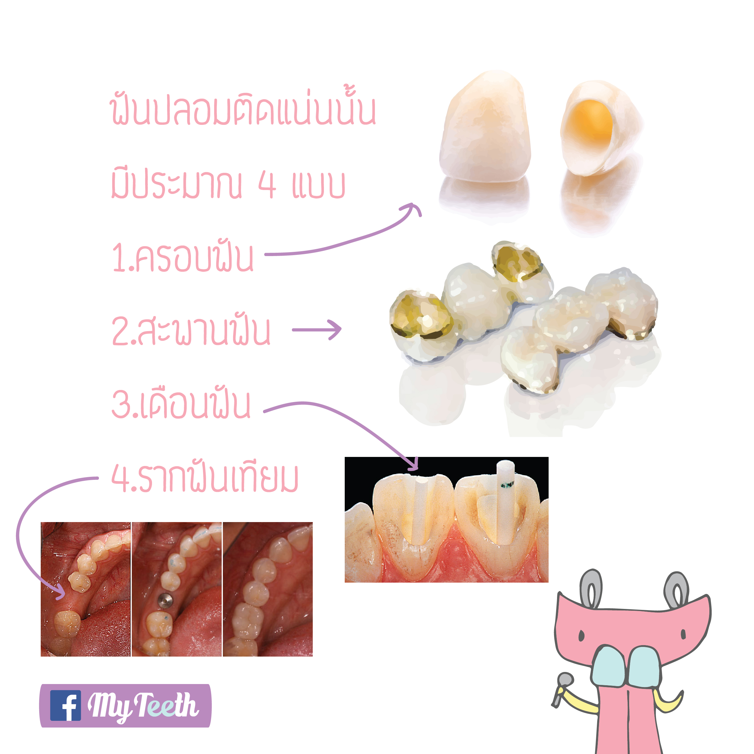 denture21-01